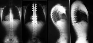 Kifoz Dereceleri Nelerdir?